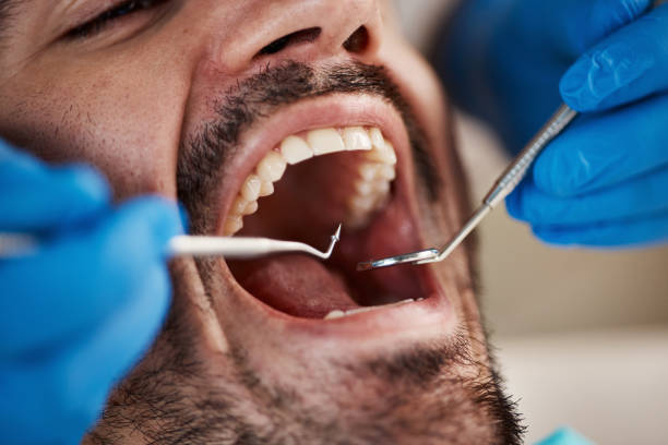 Best Emergency Tooth Extraction in Riverwoods, IL
